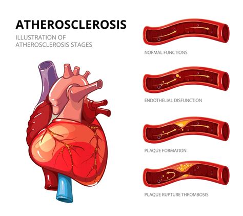 Arteriosclerotic Aortic Disease .